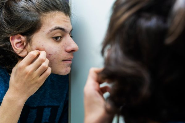 5 Cara Mengatasi Acne Cystic dengan Perawatan Rumah