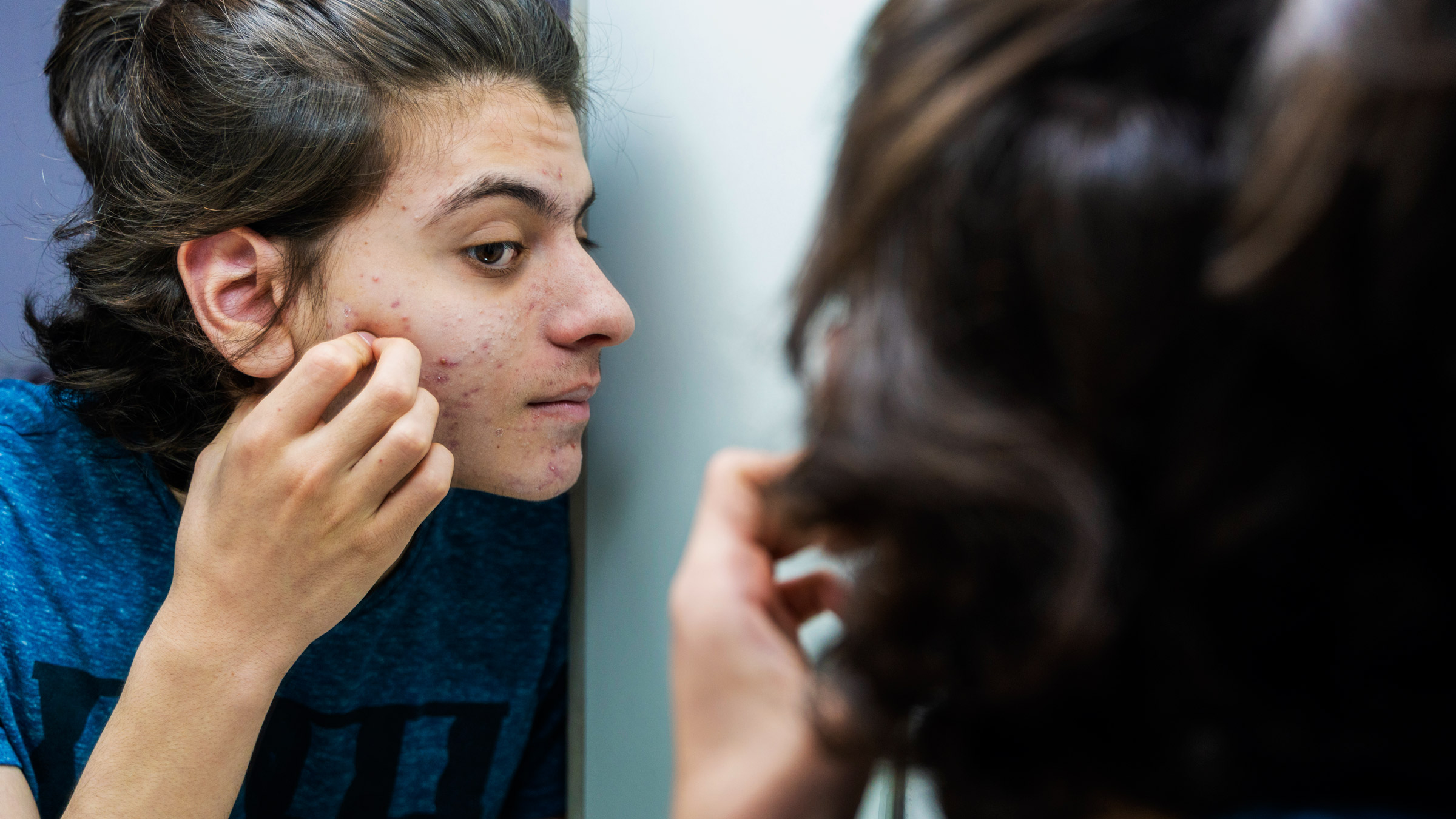 5 Cara Mengatasi Acne Cystic dengan Perawatan Rumah