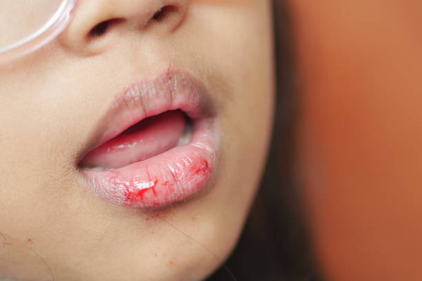 7 Hal yang Harus Dilakukan Saat Bibir Terluka atau Tersayat