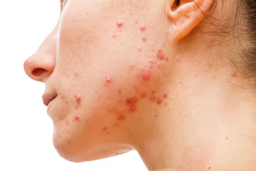5 Cara Mengatasi Jerawat Hormonal Secara Alami