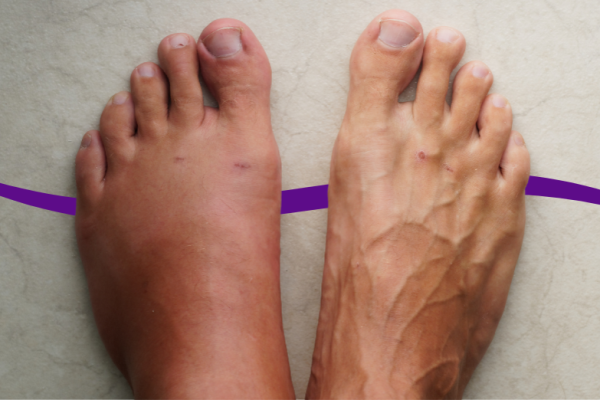 7 Cara Meredakan Bengkak di Kaki Secara Alami 7 Cara Meredakan Bengkak di Kaki Secara Alami