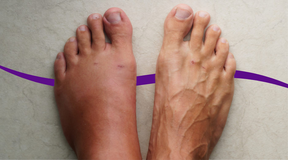 7 Cara Meredakan Bengkak di Kaki Secara Alami