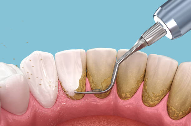 7 Tips Menghilangkan Plak Gigi secara Alami