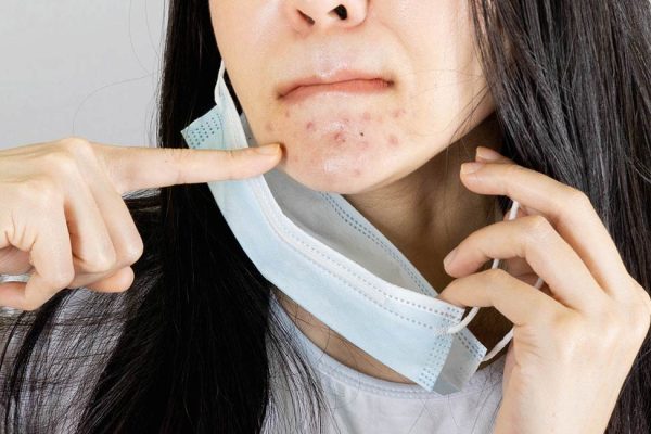 5 Cara Atasi Jerawat Akibat Pakai Masker (Maskne)
