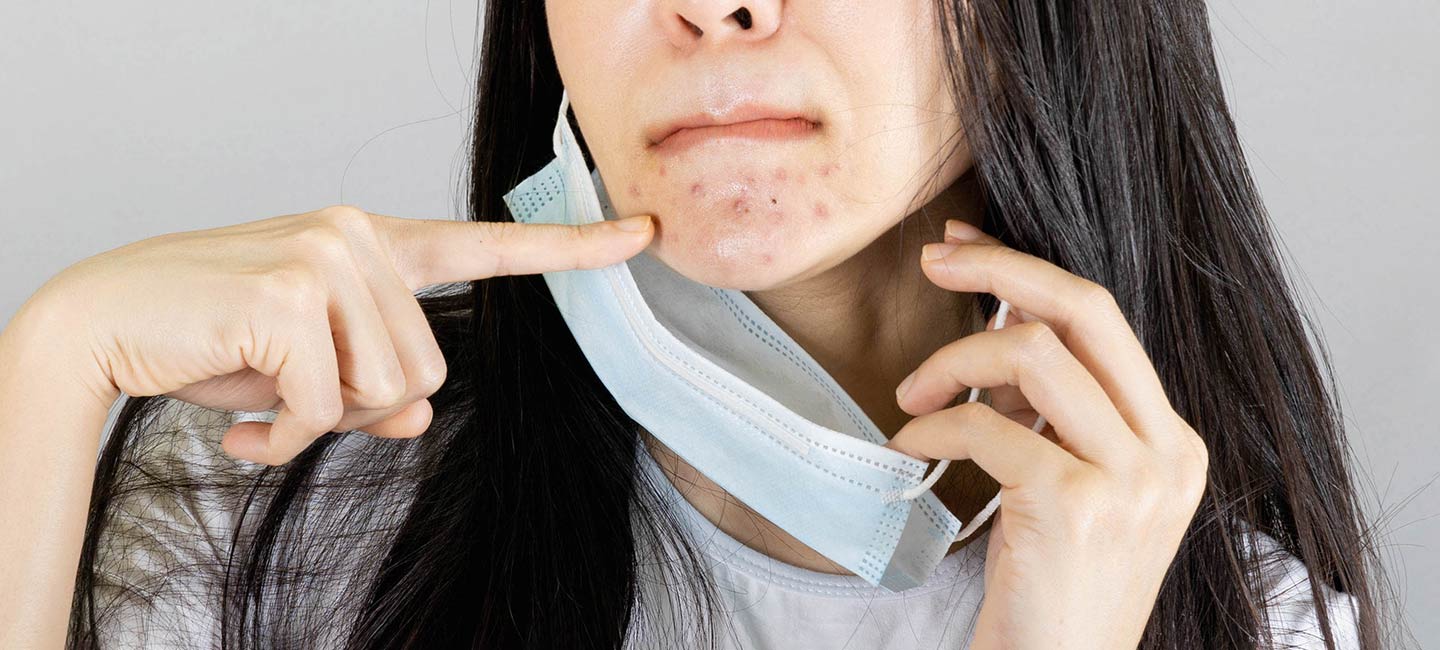 5 Cara Atasi Jerawat Akibat Pakai Masker (Maskne)